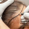 Hair Transplant for Women: A Solution for Thin Hair