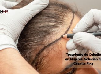 Hair Transplant for Women: A Solution for Thin Hair