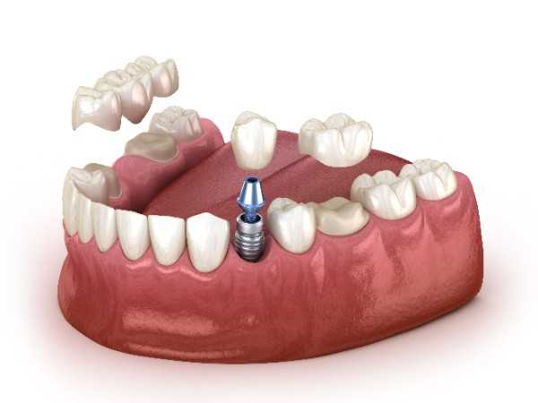 Dental implants Hereford