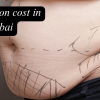 Liposuction Cost in Dubai: Complete Guide