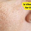Is Vitamin C Good for Open Pores?