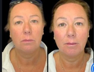 Non-Surgical Facelift Treatments in Dubai: Safe and Effective