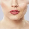 Best Acne Scar Treatment in Bangalore for Smooth Clear Skin