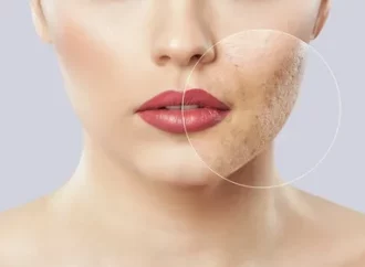 Best Acne Scar Treatment in Bangalore for Smooth Clear Skin