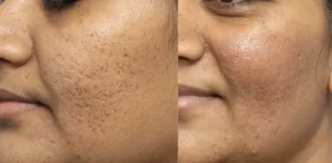 Acne Scar Treatment