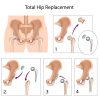 Benefits and Risks of Hip Replacement Surgery You Should Know