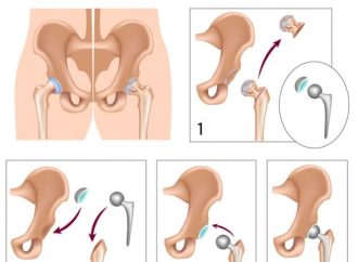 Benefits and Risks of Hip Replacement Surgery You Should Know