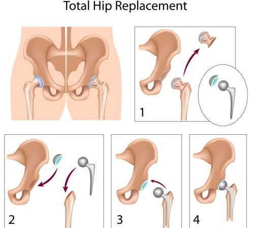 Benefits and Risks of Hip Replacement Surgery You Should Know