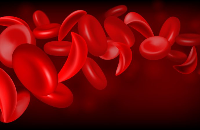 Top Modern Therapies Transforming Sickle Cell Anemia Care