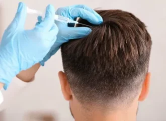Non-Surgical Hair Replacement: A Natural Hair Loss Solution