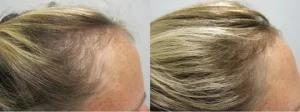 Hair Replacement