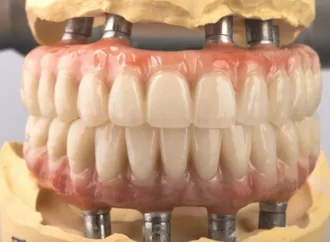 All-on-4 Dental Implants Bakersfield at San Dimas Dental Care