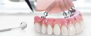 all-on-4 dental implants