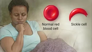 Sickle Cell Anemia