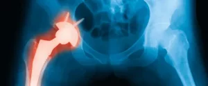 minimally invasive hip replacement
