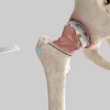 Minimally Invasive Hip Replacement: Benefits & Recovery Guide