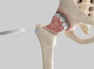 Minimally Invasive Hip Replacement: Benefits & Recovery Guide