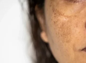 Melasma Treatment in Brisbane: Pigmentation Care Guide