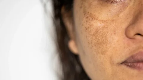 Melasma Treatment in Brisbane: Pigmentation Care Guide