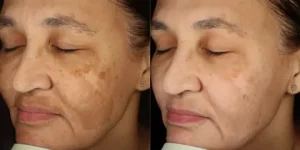 Melasma Treatment