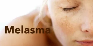 Melasma treatment Brisbane
