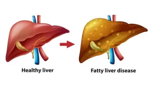 Liver Nutritionist