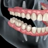 Full Mouth Rehabilitation Using the Single Design Concept Guide