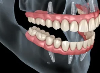 Full Mouth Rehabilitation Using the Single Design Concept Guide