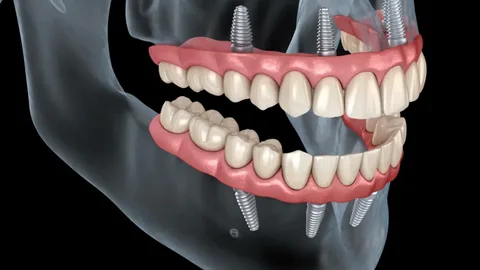 Full Mouth Rehabilitation Using the Single Design Concept Guide