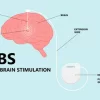 Deep Brain Stimulation Cost in India: Treatment & Benefits