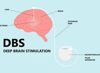 Deep Brain Stimulation Cost in India: Treatment & Benefits