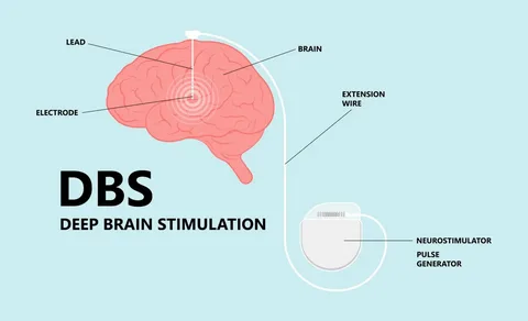 Deep Brain Stimulation Cost in India: Treatment & Benefits
